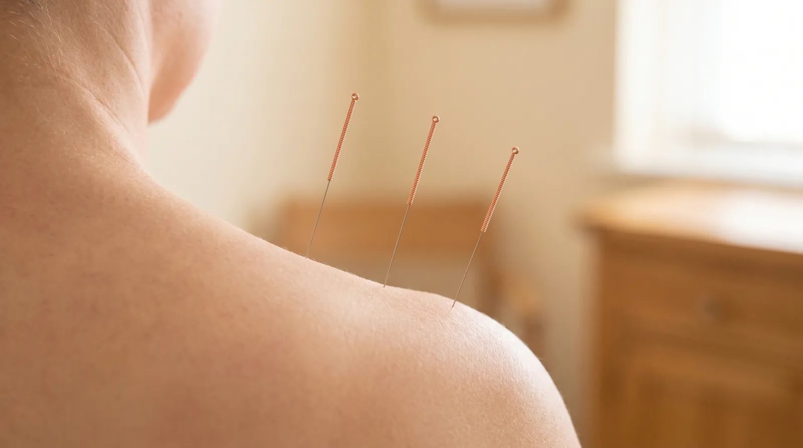 Fine acupuncture needles placed in a relaxed shoulder during a treatment in South Surrey